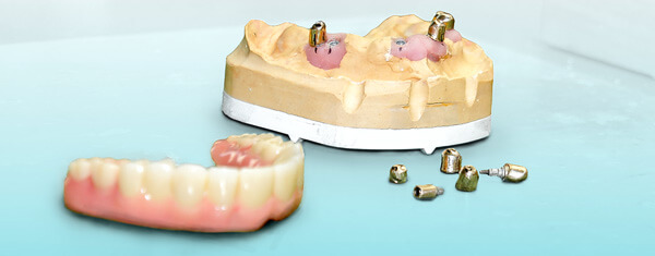 Hochwertiger und langlebiger Zahnersatz durch Implantate