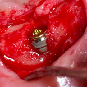 5. Vollständiger Einsatz des Implantats